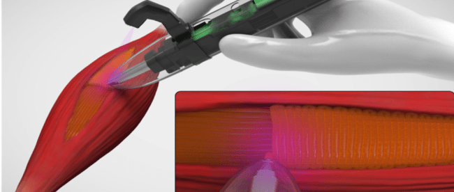 computer generated image shows how the 3d bioprinter can place tissue in the defect site of the muscle. A hand is seen holding the bioprinter right over the muscle that requires regrowth